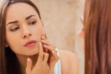 Você pode prevenir a acne com uma rotina de cuidados correta.